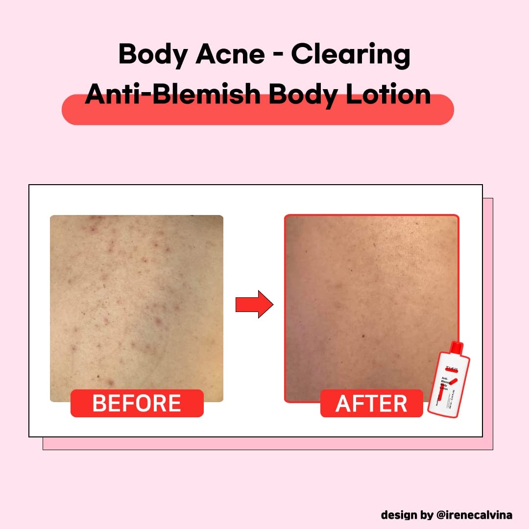 TIAM Anti-Blemish Body Lotion, Body Acne Treatment, Bacne, Great for Fighting Breakouts and Acne Scars Removal, 6.76 OZ